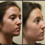 How to Care for Your Skin After Laser Resurfacing Dr  West