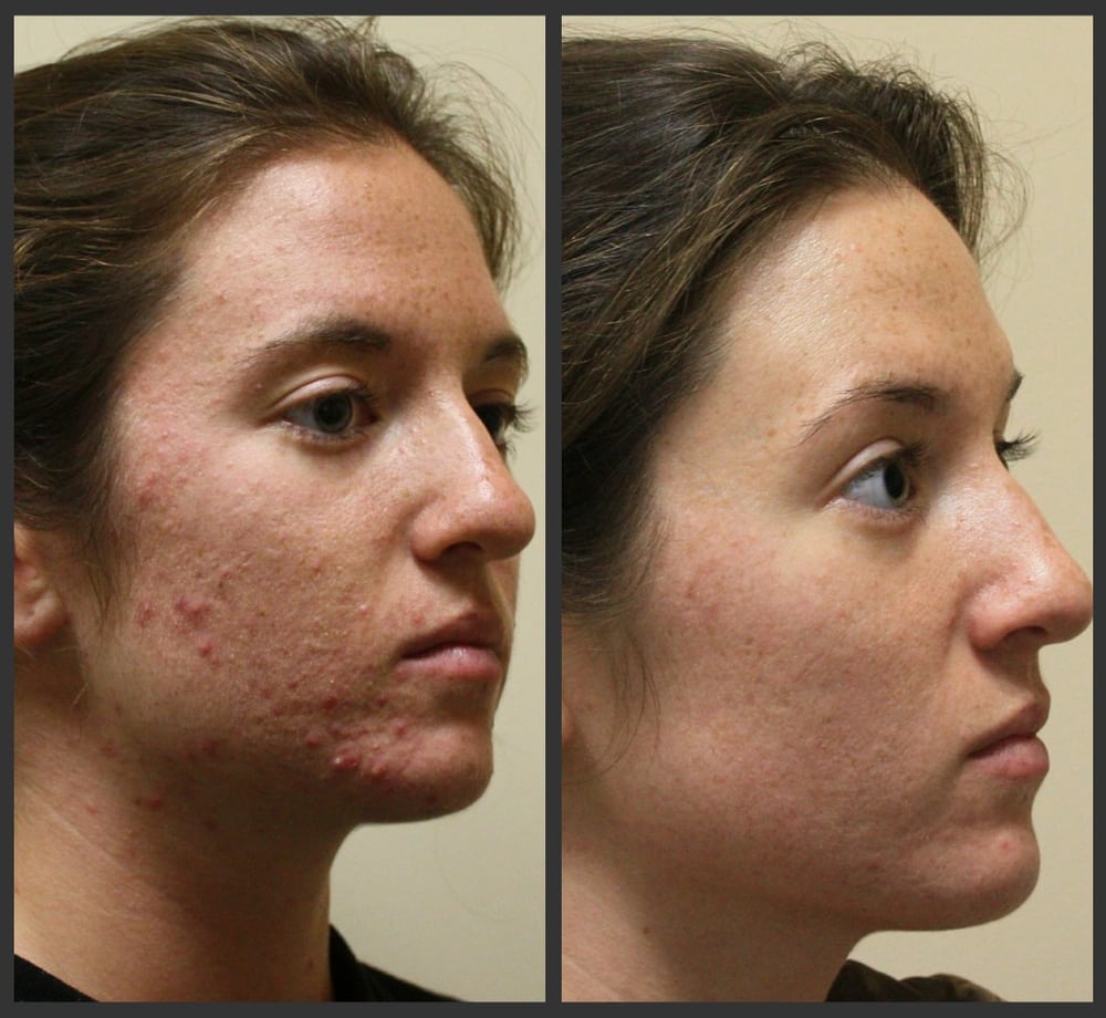 How to Care for Your Skin After Laser Resurfacing Dr  West