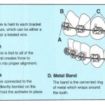 How Do Braces Work to Straighten Your Teeth?