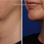 How Long Does the Swelling Last after Liposuction?