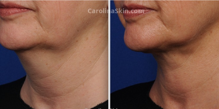 How Long Does the Swelling Last after Liposuction?