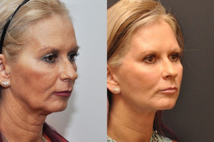 How to Choose Between Liposuction and Noninvasive Fat Reduction Procedures ABCS