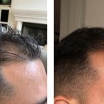 How close is a cure for baldness? Men’s hair