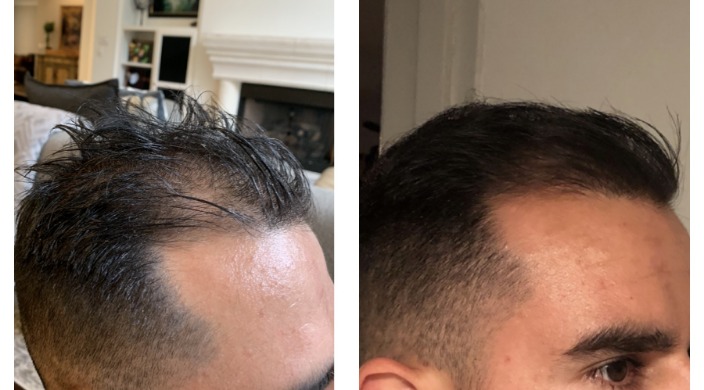 How close is a cure for baldness? Men’s hair