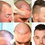 Revitalize Your Look with Premier Hair Transplant Services in London