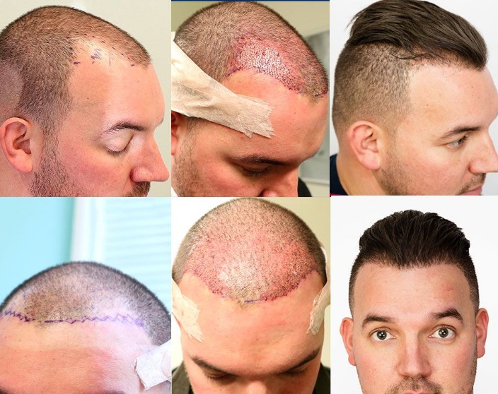 Revitalize Your Look with Premier Hair Transplant Services in London